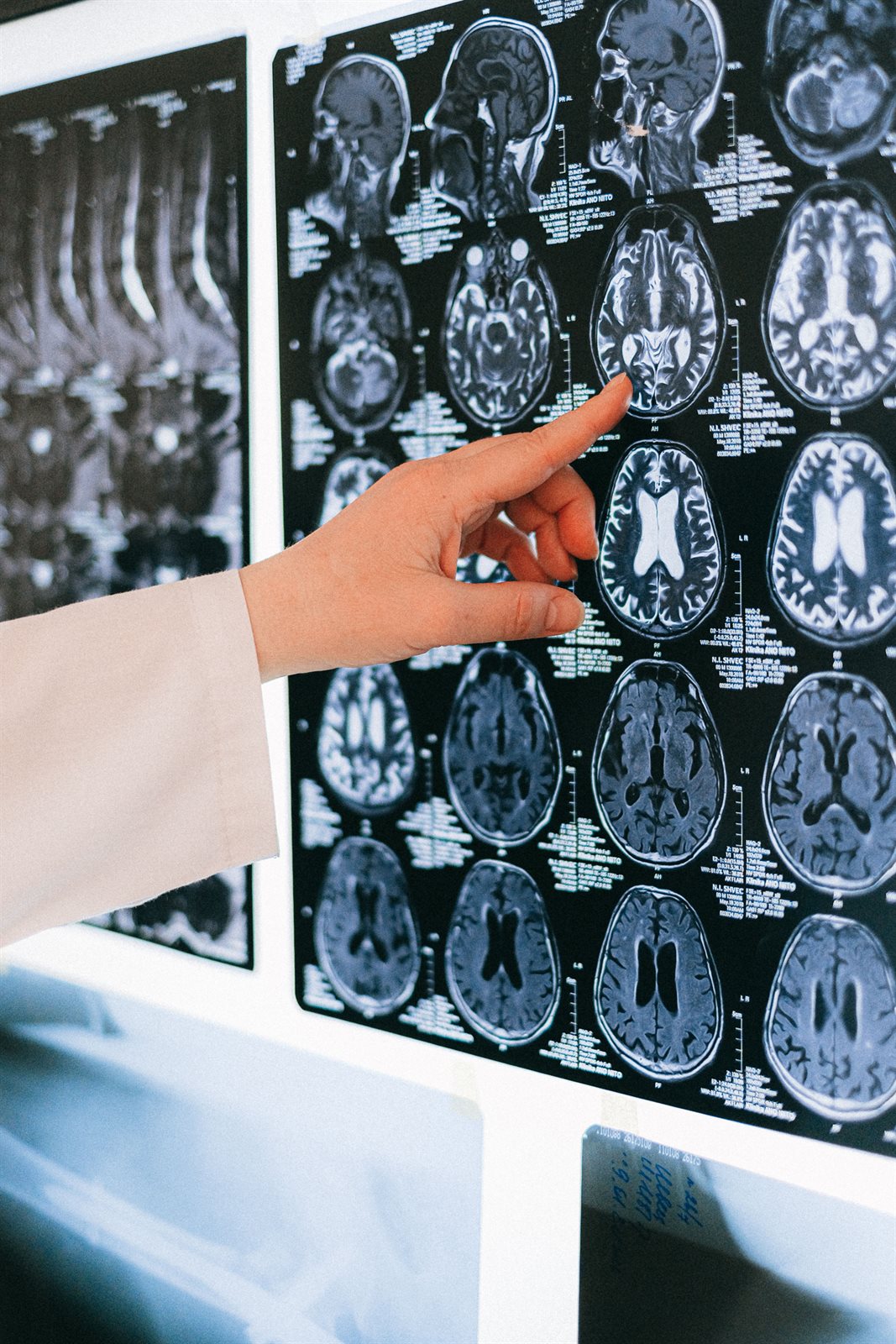 O mână indică o secțiune cerebrală pe o planșă cu imagini medicale.